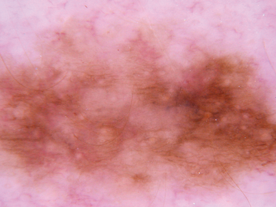 melanoma