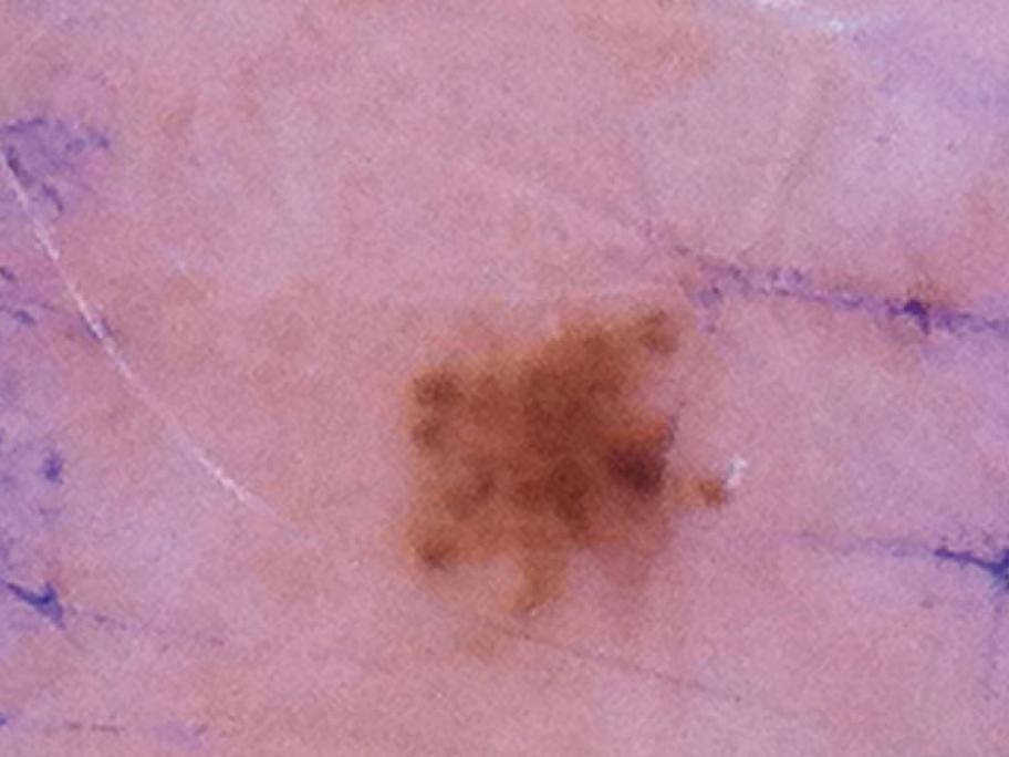 A minute pigmented skin lesion