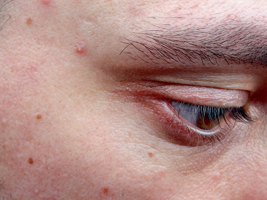 persistant acne