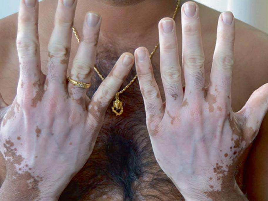 Vitiligo