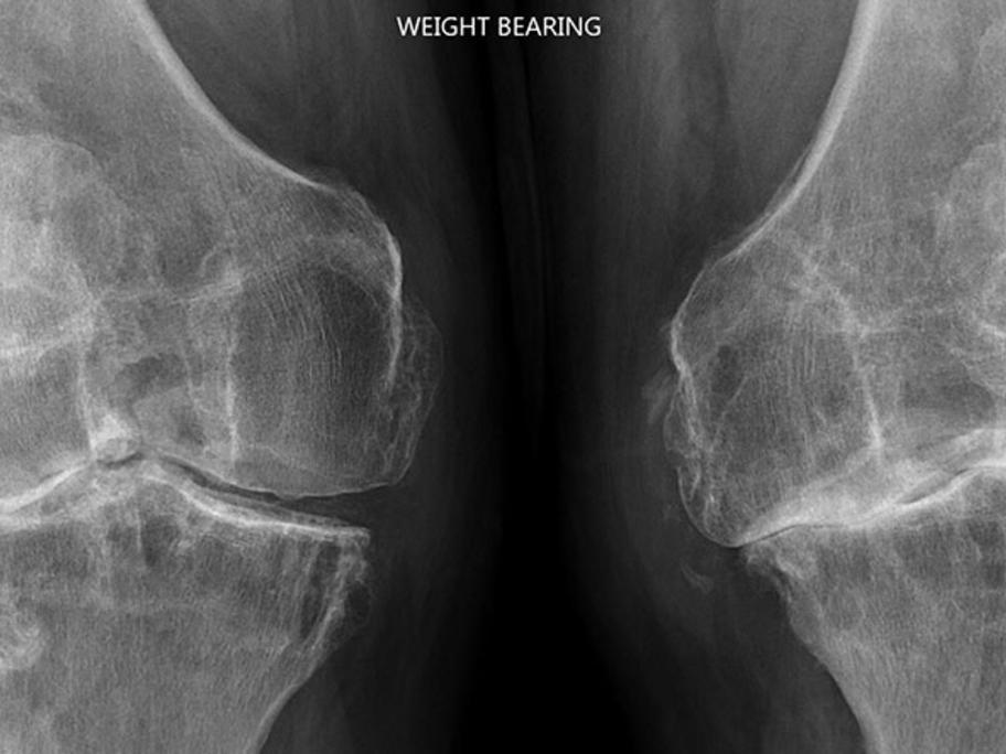 X-ray showing OA of the knee