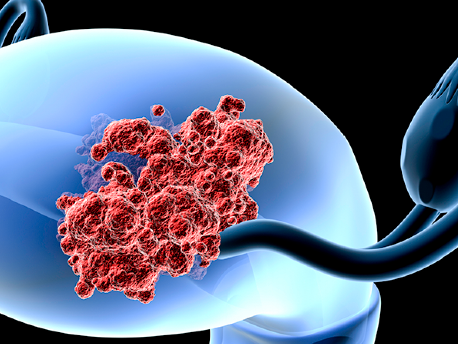 endometrial cancer