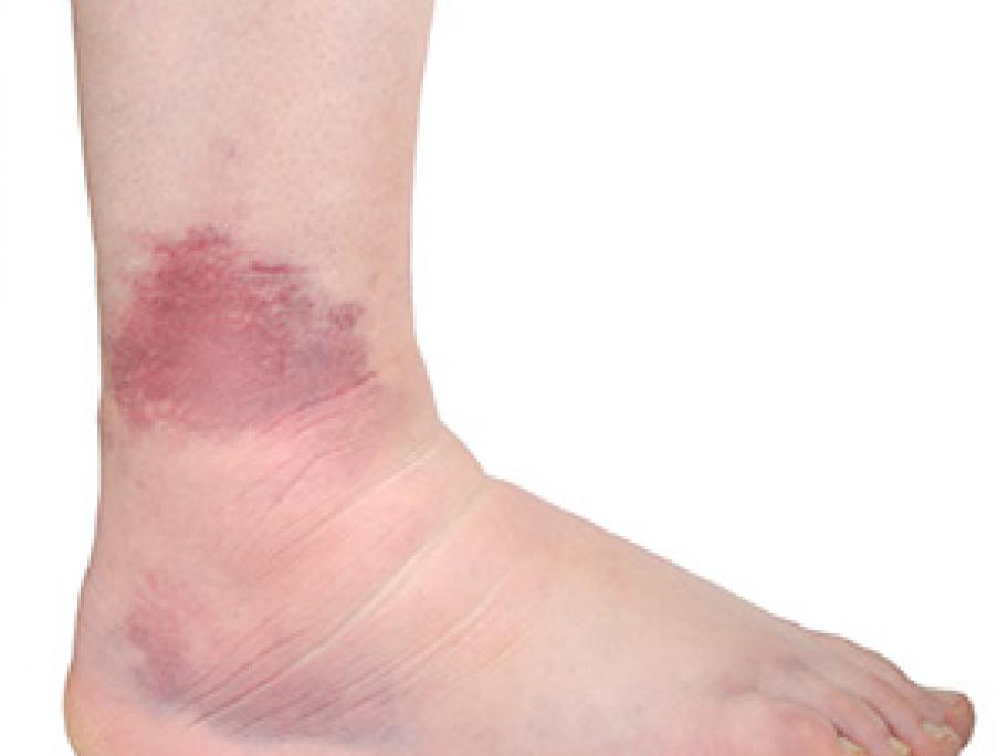 sprained ankle