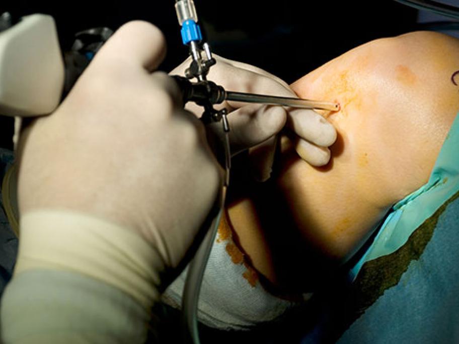 arthroscopy