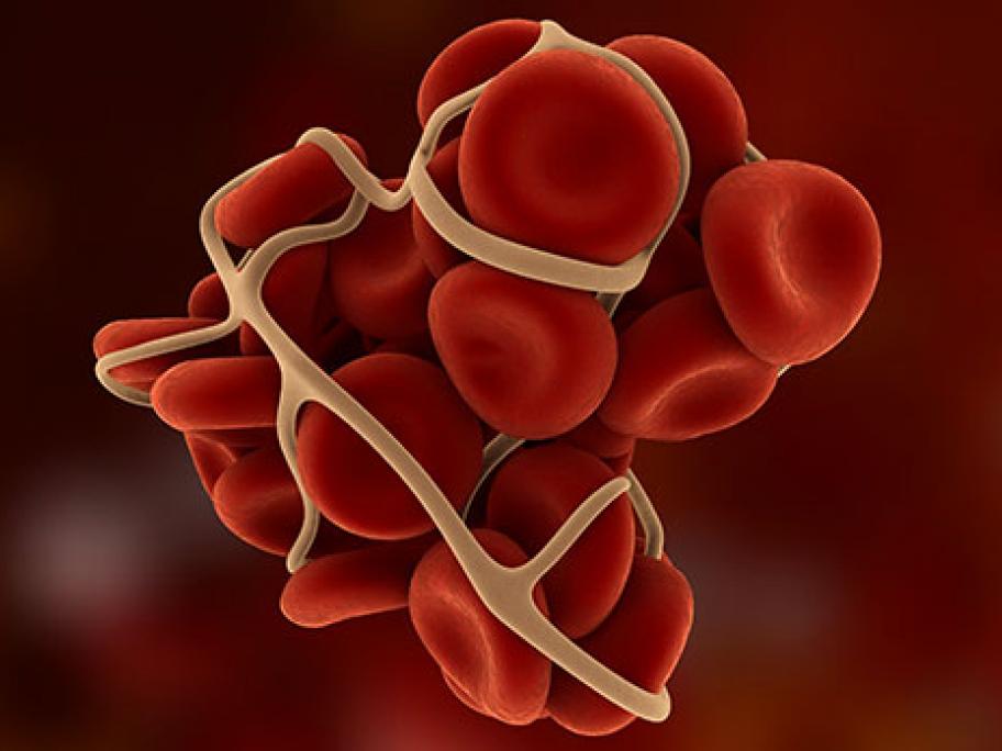 blood clot