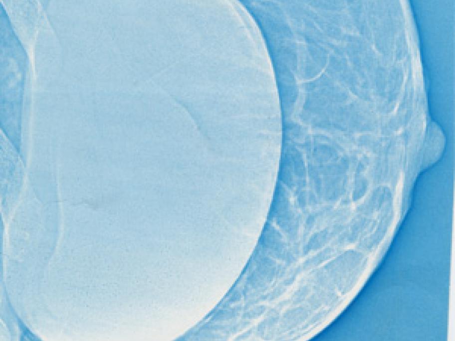 Breast implant