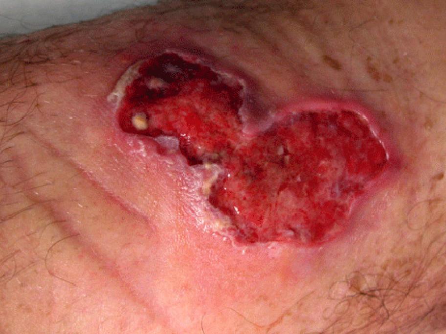 buruli ulcer
