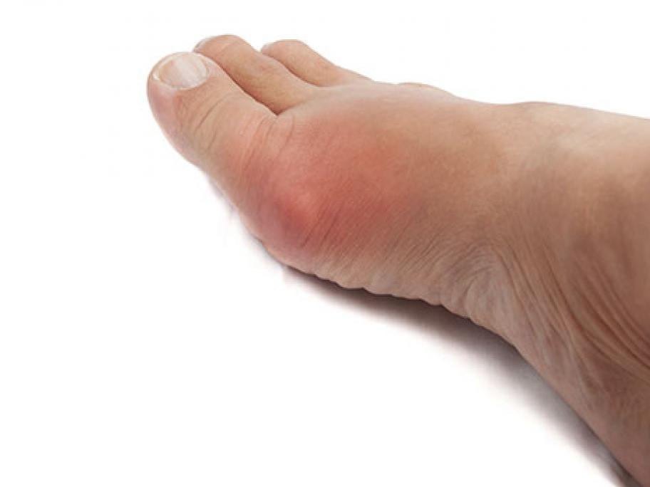 foot with gout