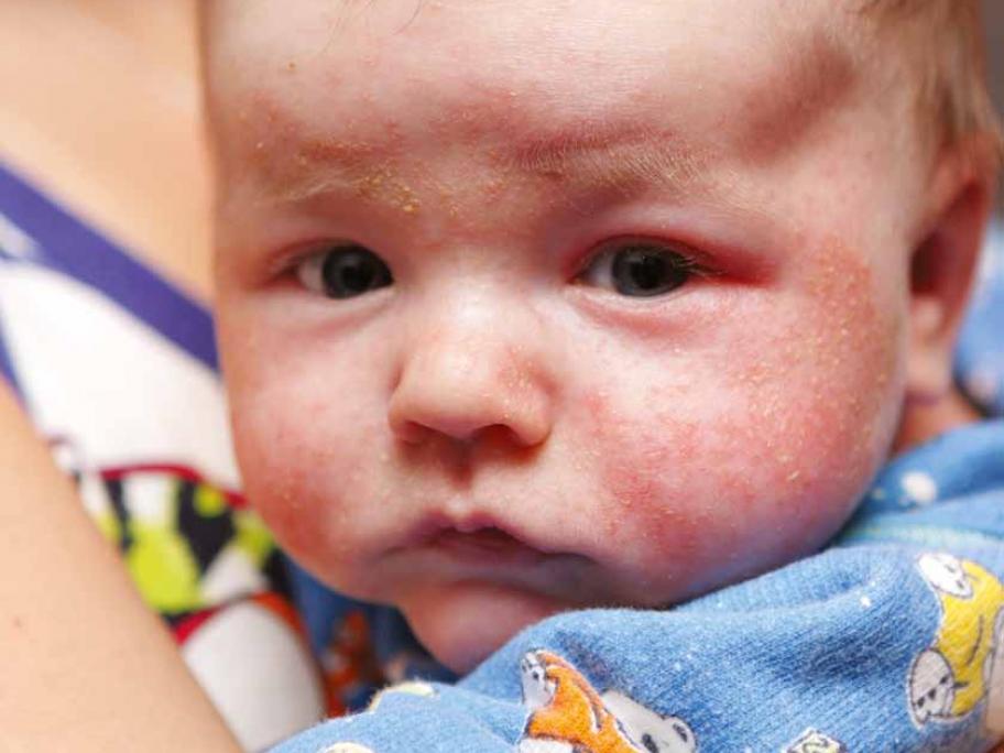 eczema