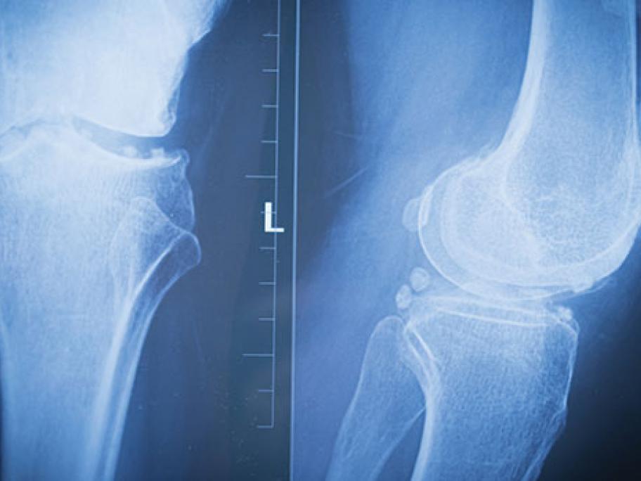 Knee X-ray