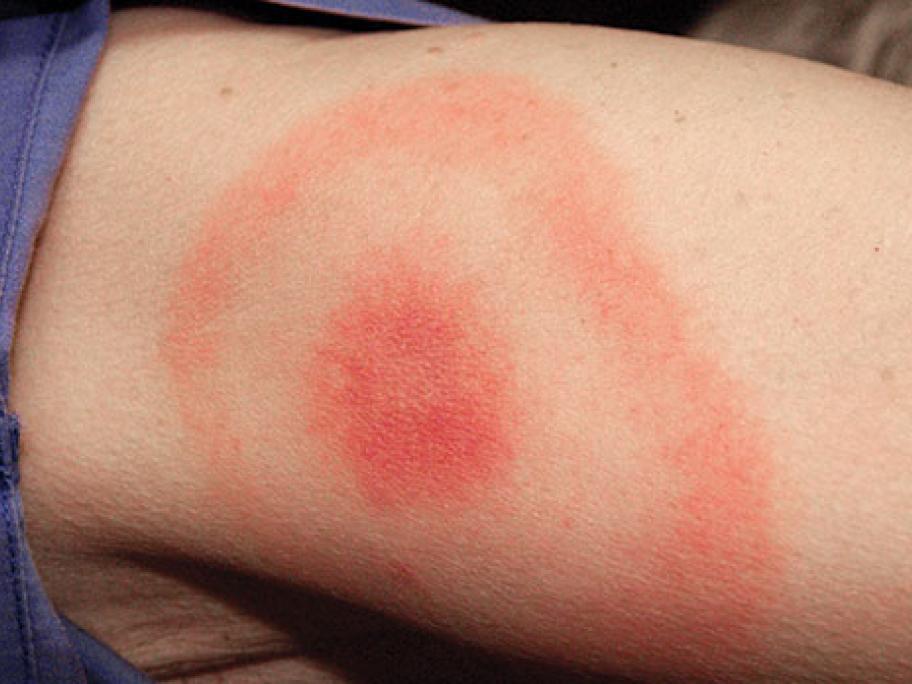 Bullseye rash