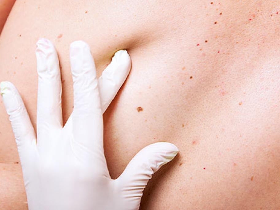 Melanoma skin examination