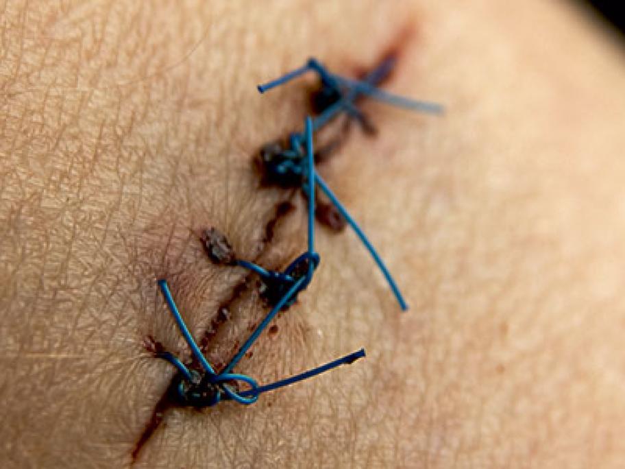 melanoma excised
