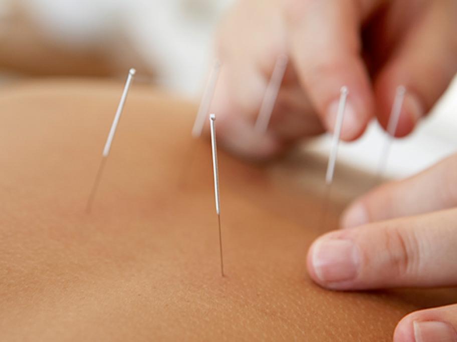 acupuncture