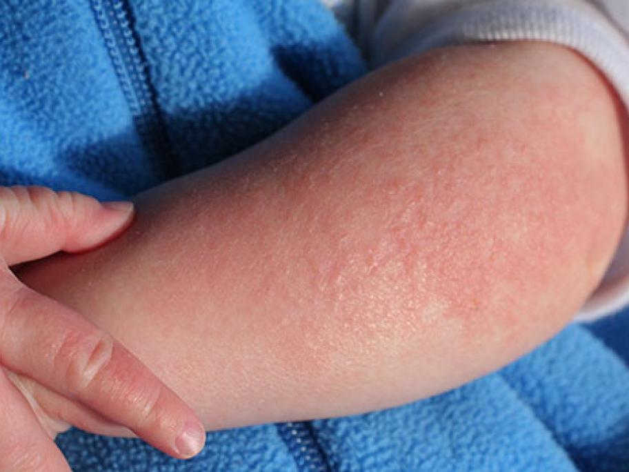 eczema and ADHD