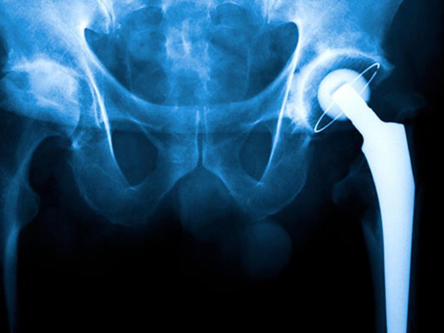 hip replacement