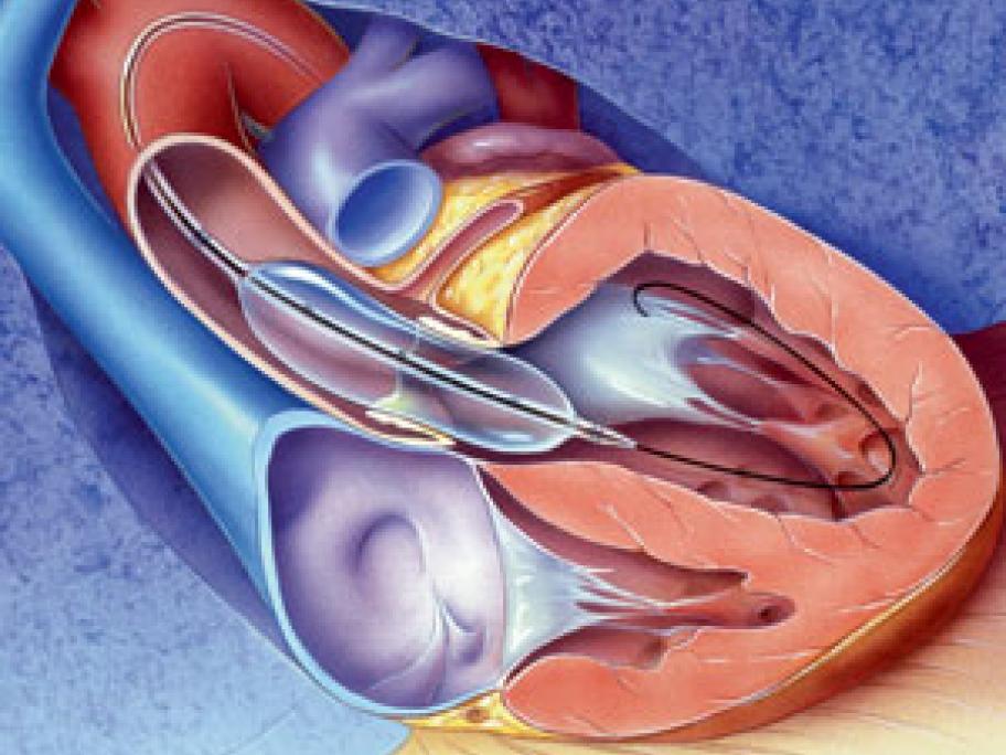 A case of severe mitral valve stenosis | Australian Doctor Group