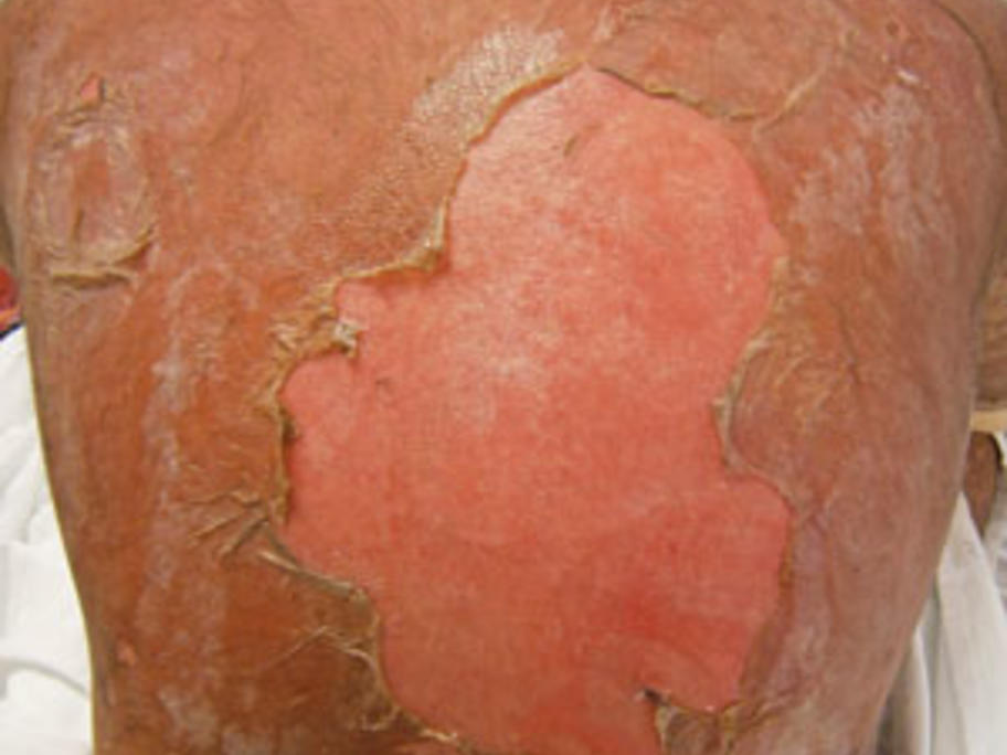 toxic epidermal necrolysis