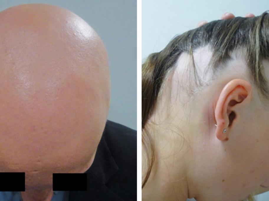 alopecia