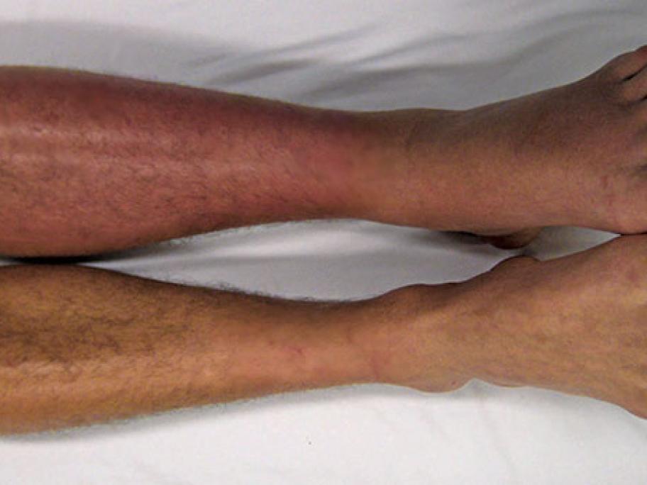 deep vein thrombosis
