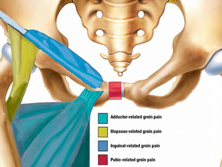 Case Report Getting To Grips With Groin Pain Australian Doctor Group