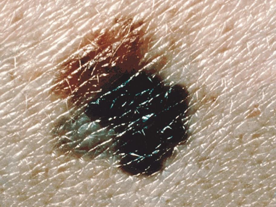 melanoma