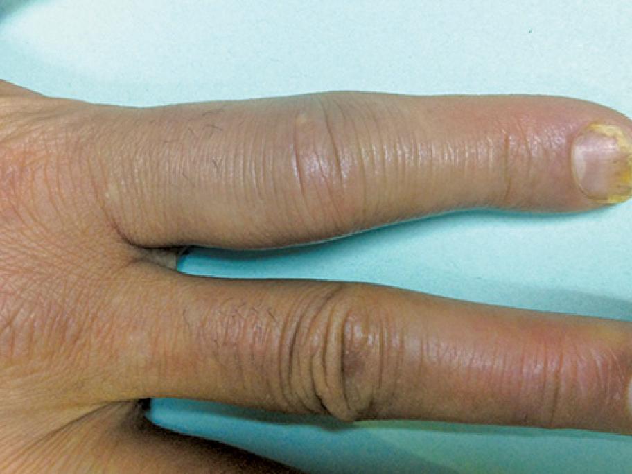 Fungal infection
