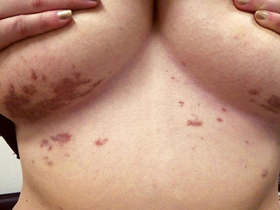lichen planus