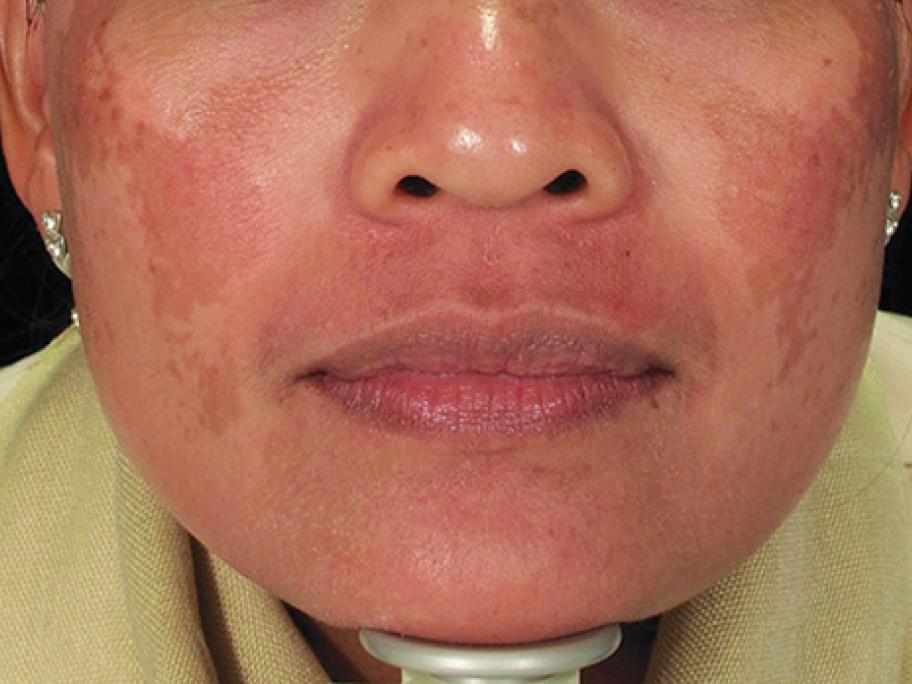 melasma