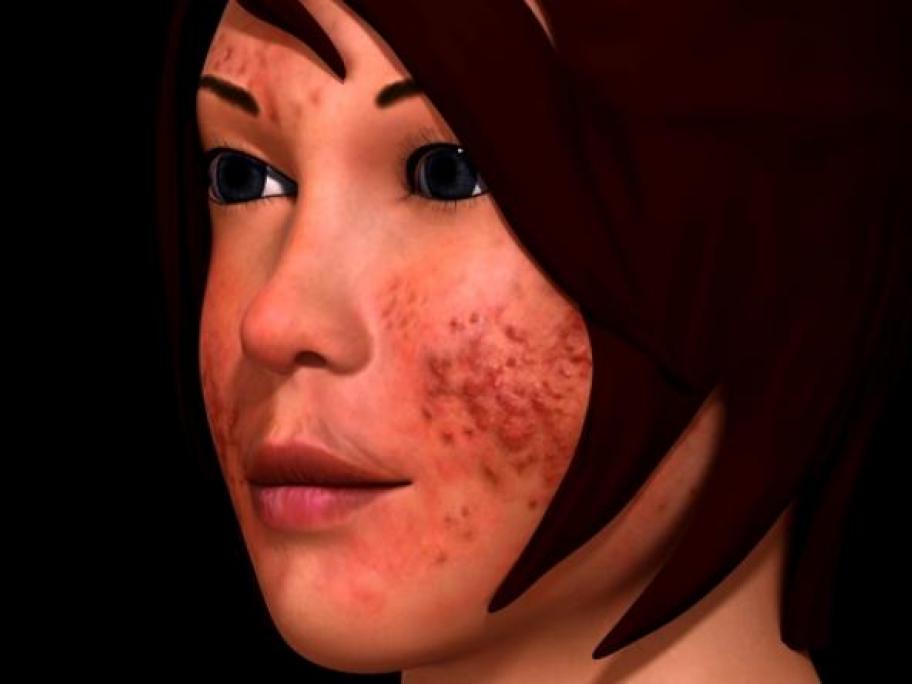Why acne risk goes beyond the dermatological symptoms