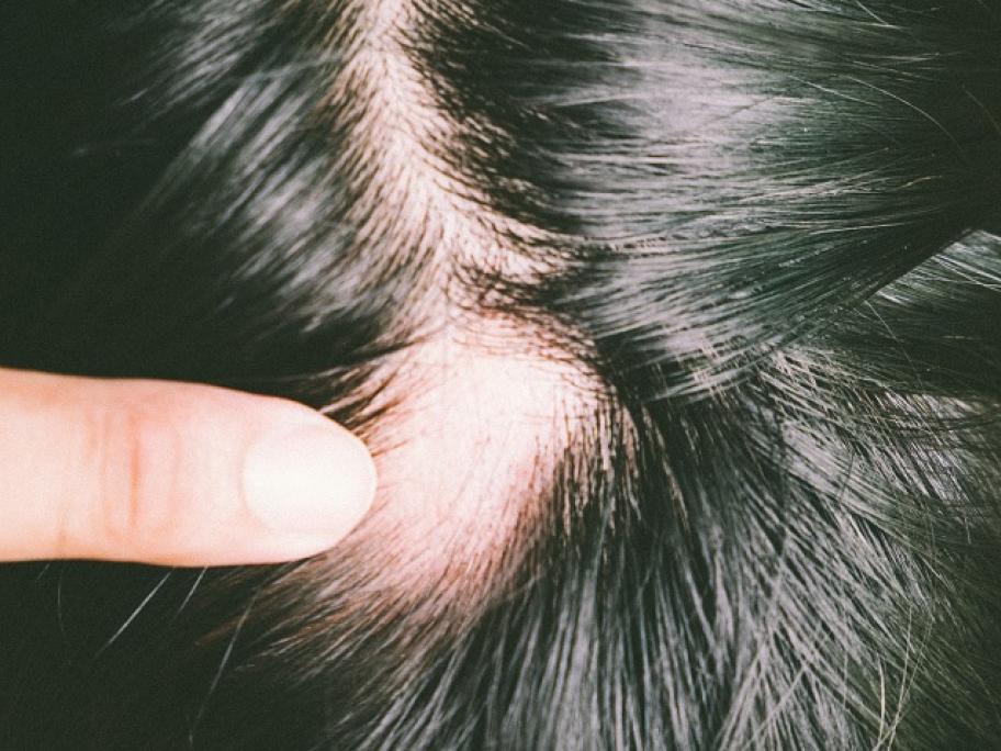 alopecia areata