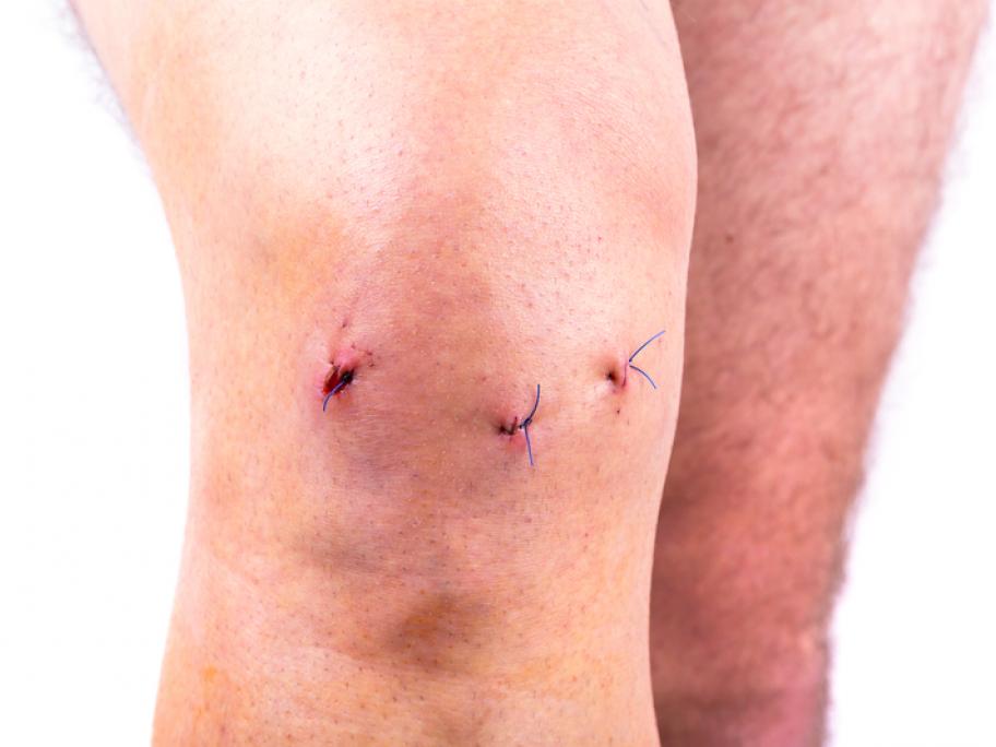 Warning against unnecessary knee surgery