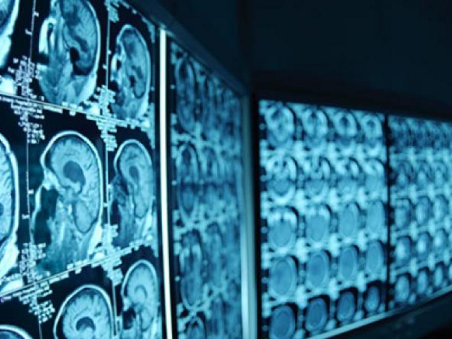 Challenger thrombolytic prevails in battle of the clot-busters