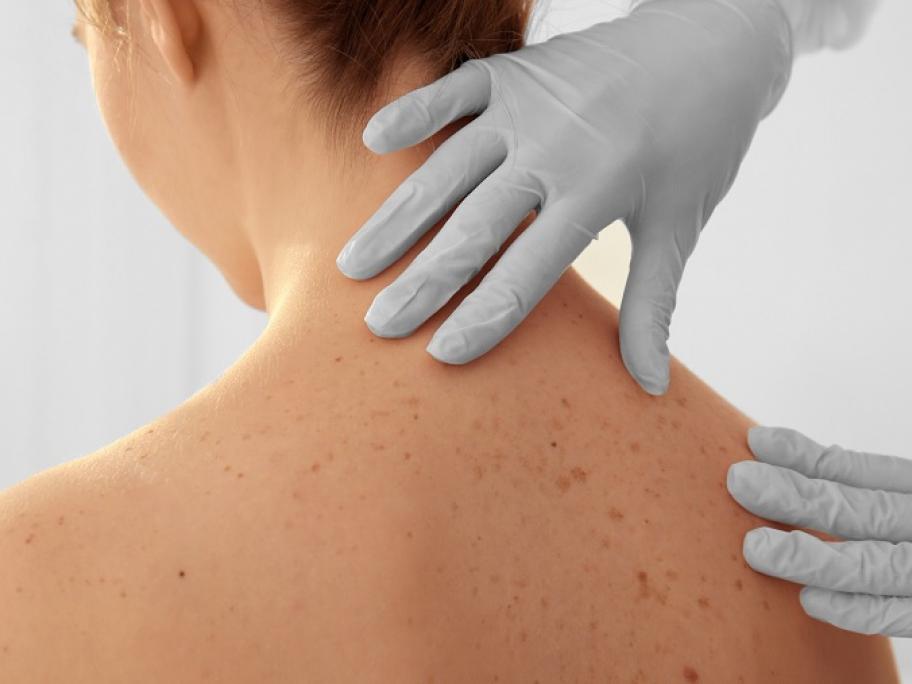 checking moles