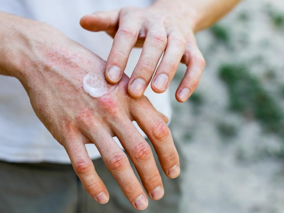 eczema
