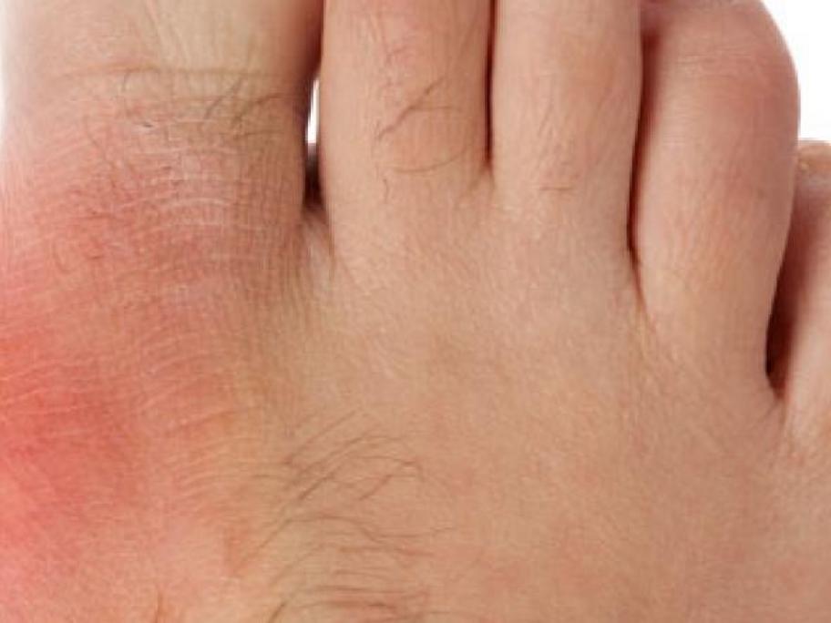 Gout