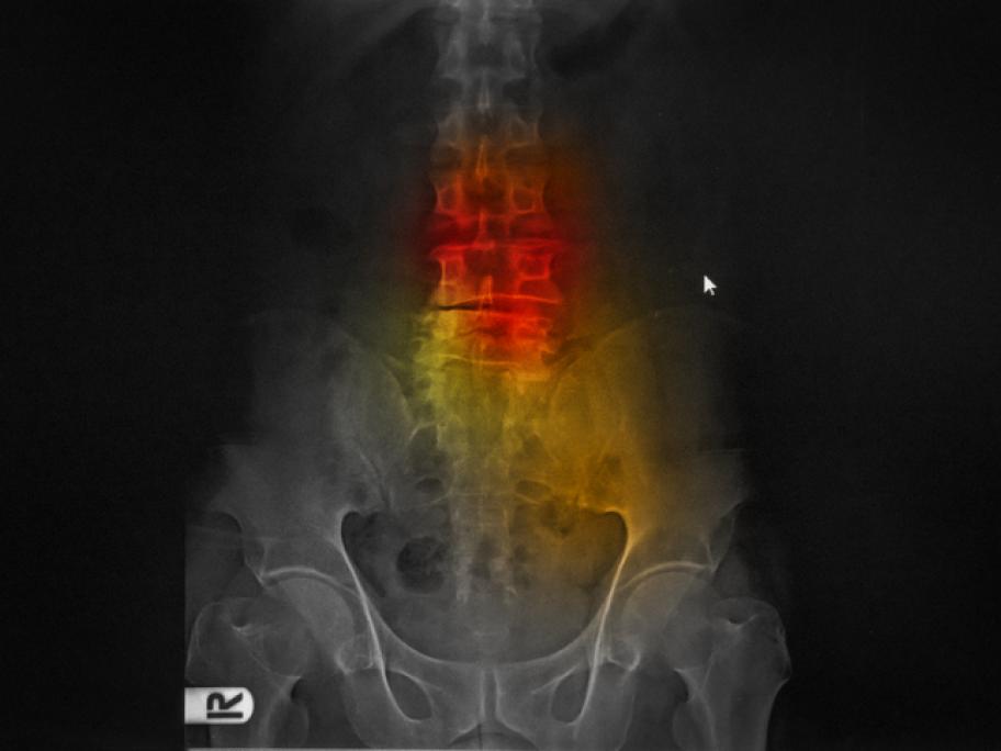 Ankylosing spondylitis