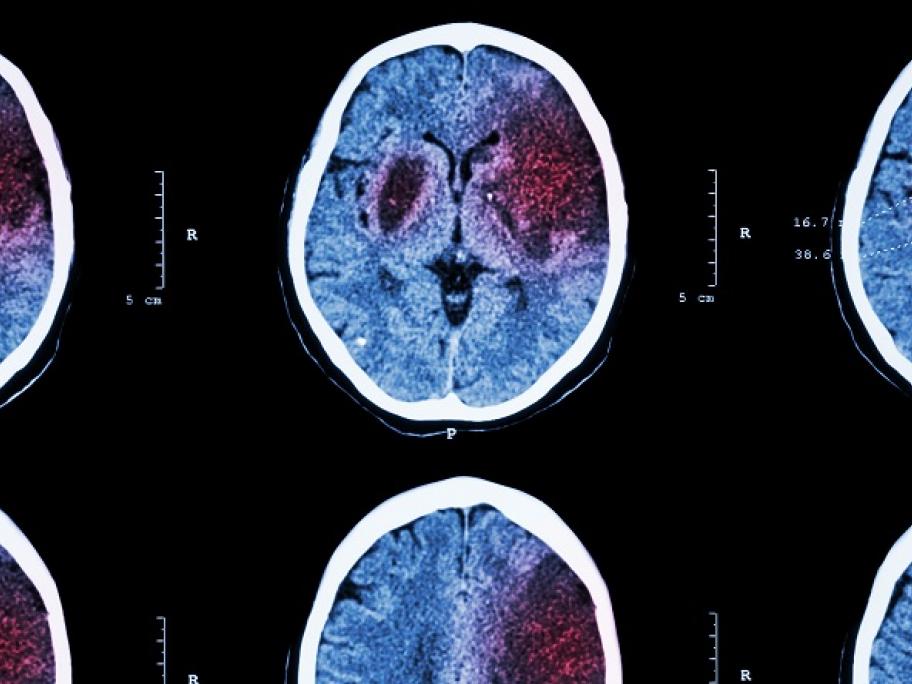 stroke concept