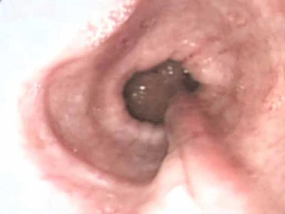 NG tube