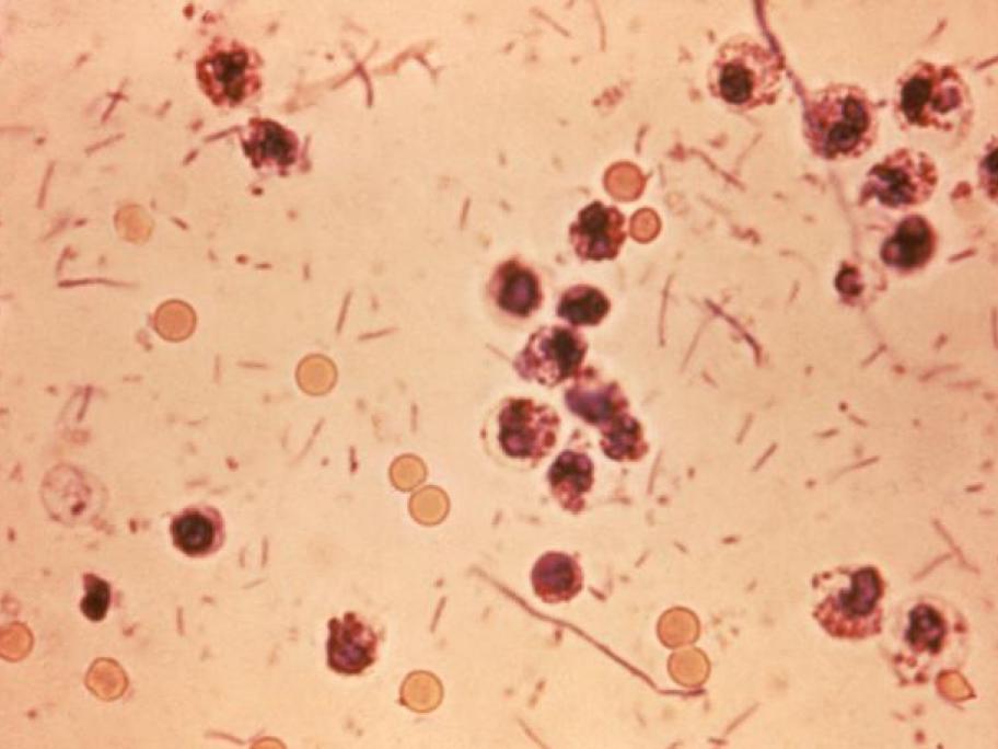 Shigella bacteria in a stool sample