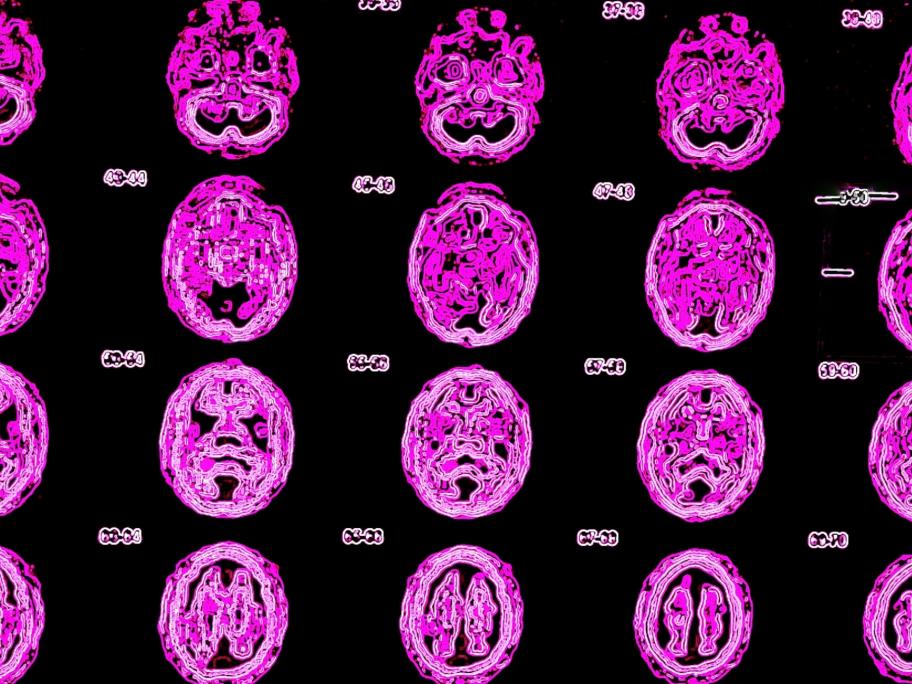 PET scan