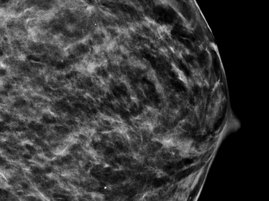 3-D breast scan image