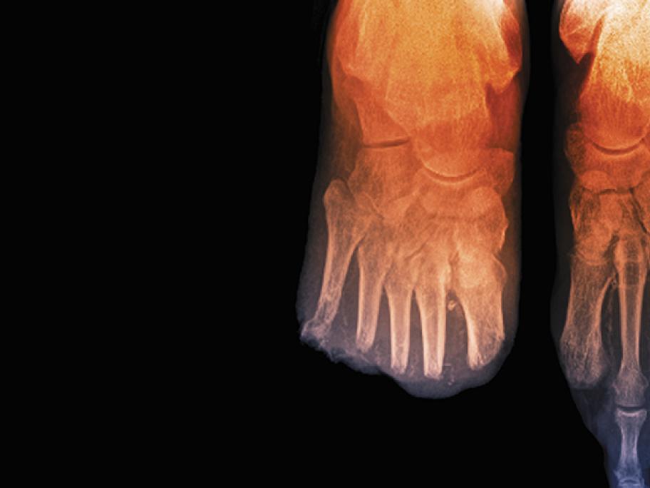 Toe_amputations_in_diabetes_X-ray