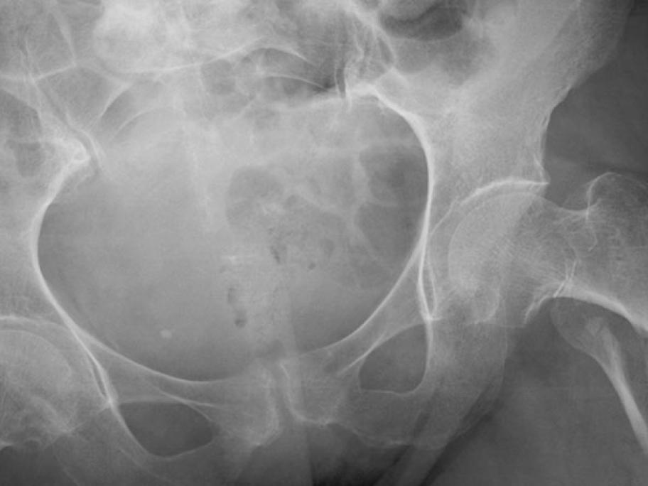 femur fracture