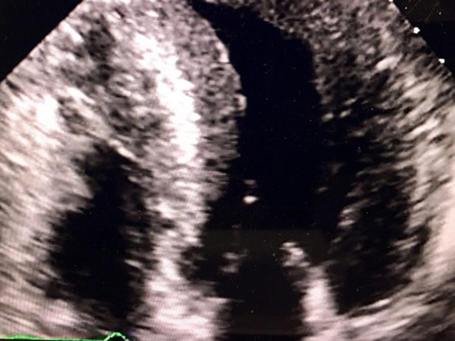 echocardiogram