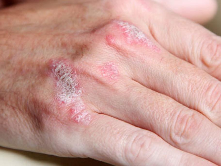 hand with psoriasis plaques