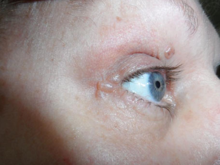 White Bump On Upper Eyelid 