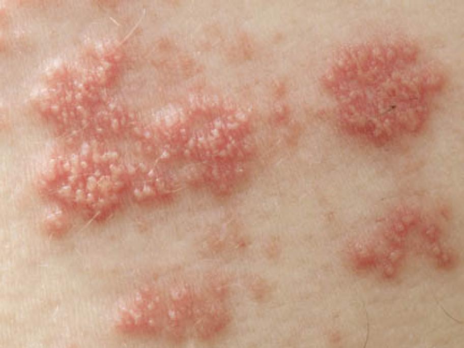 Shingles