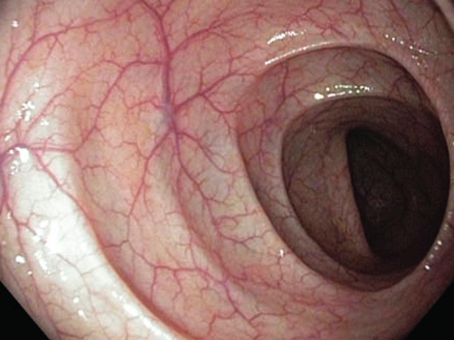 Colonoscopy