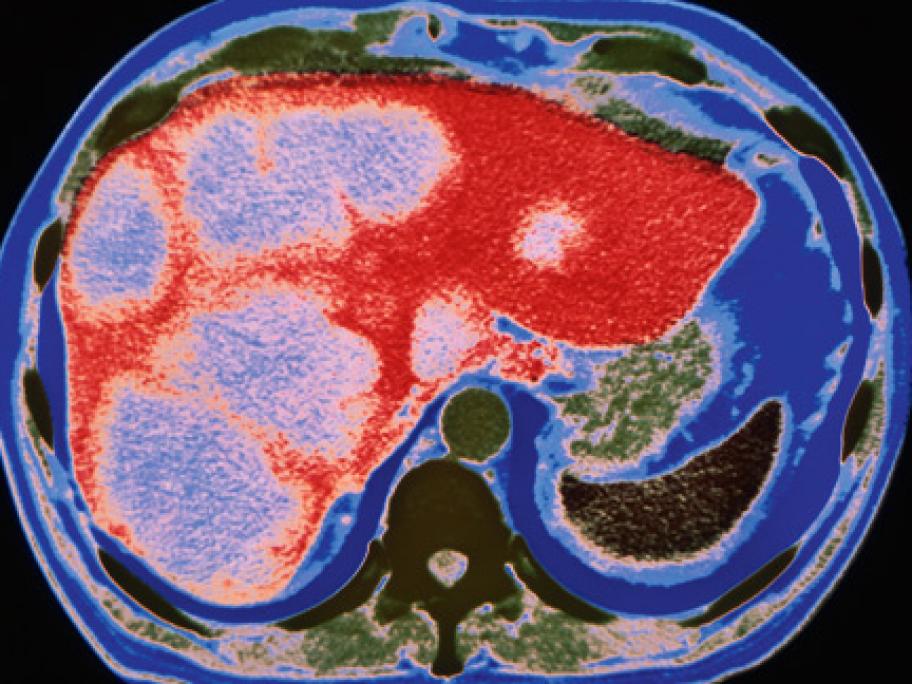 CT scan showing liver cancer